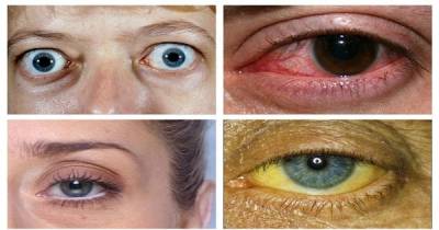 The Surprising Ways In Which Your Eyes Are Telling You There Is Something Wrong With Your Health