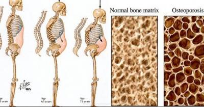 Doctors Say This Drink Destroys Your Bones From The Inside And Harms Every Organ On Its Way Out