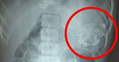 Three Stone Parasite Twin With Hair And Teeth Caused Teenager's Stomach Pains