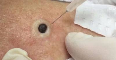 For Years She Thought It Was Just A Mole. Then Her Doctor Informs It Isn&rsquo;t. What She Yanks Out? OMG!