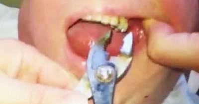 Dude Rips Out His Own Tooth With Pliers