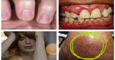 Common Symptoms That You Have A Serious Vitamin D Deficiency And What You Can Do About It