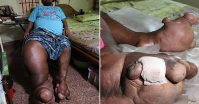 Indian Man's Limb Now Weighs The Same As A Baby Elephant Due To Mystery Genetic Disorder
