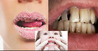 Do You Think Sugar Is What Causes Cavities In Your Teeth?? Think Again!