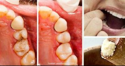 Heal Tooth Cavities Yourself And Relieve Pain Quickly At Home