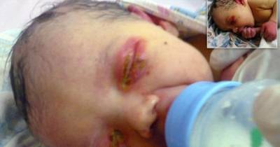 This Abandoned Baby Girl Was Found When She Was Being Eaten Alive By Ants