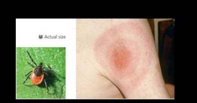 Revealed &ndash; New Species Of Bacteria Is Being Held Responsible For Lyme Disease