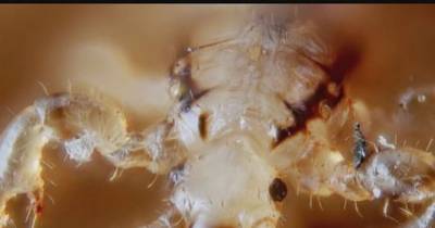 Omg!'Super Lice' Hits 25 States In The US!