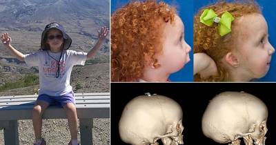 Little Girl Born With No Lower Jaw Bone Endures 11 Operations To Rebuild Her Face, What Happen Next Is Shocking