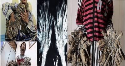 Bangladesh's Tree Man Undergoes Successful Surgery