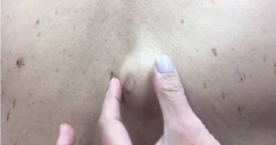 When The Doctor Goes To Drain This Thing On His Back It Explodes