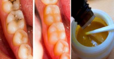 Reverse Cavities Naturally And Heal Tooth Decay With This Powerful Tooth Mask