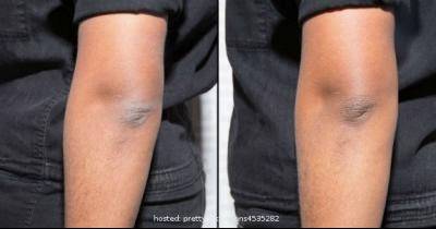 11 Ways Suggested By Dermatologists To Get Rid Of Dry, Ashy Skin