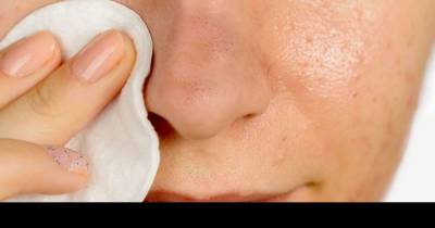 How To Use Hydrogen Peroxide To Remove Blackheads