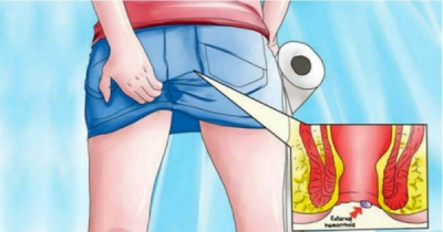 They Itch And They Bleed! Here Is One Natural Solution For Healing Hemorrhoids Fast And Easy!