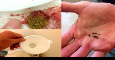 Watch Your Kidneys Stones Come Out With This Amazing Home Remedy