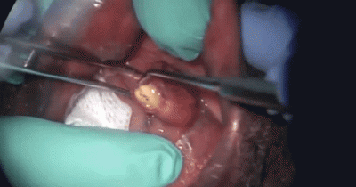 You Won't Believe What They Had to Remove From This Guy's Mouth!