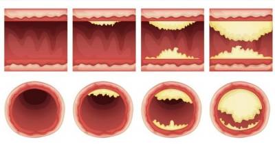 10 Foods That Unclog Arteries Naturally And Protect Against Heart Attack