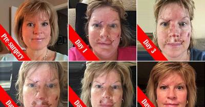 This Is What Skin Cancer Looks Like - Shocking Pictures Show The Results Of Invasive $27,000 Surgery