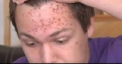 Kid Claims He Got Face Herpes While Playing School Sports