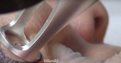 Doctor Uses Hi-Tech Laser To Pop Patient's Spot And The Results Are Horrifying