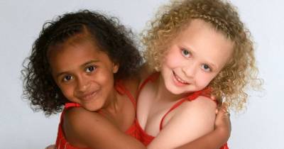 Unique Sets Of Twins Who Defied The Odds