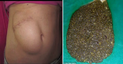 She Went To The Doctor With Stomach Pain, But When He Saw 12,000 Of These In Her He Screamed!