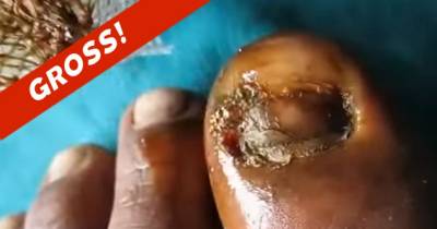 Repulsive Footage Shows Doctor SCRAPING Back Layers Of Infected Toenail With Scalpel