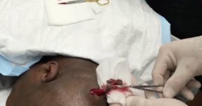 Cyst The Size Of Golf Ball Is Removed From Pilot's Head With Pair Of Pliers