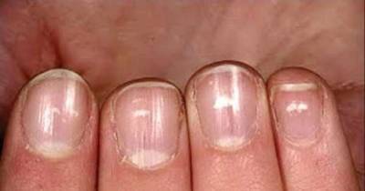 Red Alert: If You See This On Your Nails Immediately Visit A Doctor!