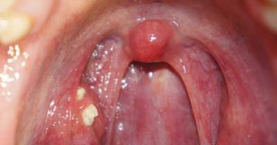 Tonsil Stone Removal 101: How To Deal With Nasty Tonsil Stones.