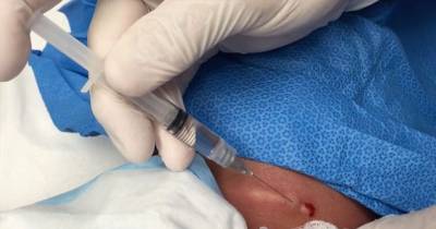 Gruesome Video Shows A Man's Neck Swelling EXPLODING With Pus As It Is Drained By A Doctor