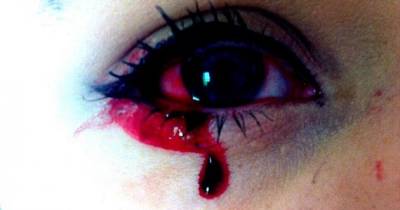 17-Year-Old Suffers From Mystery Condition Which Causes Blood To Seep From Her Eyes Five Times A Day
