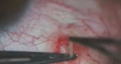 Giant Parasitic Worm Pulled From Man's Eye In Gruesome Surgery Video That's Not For The Faint Hearted
