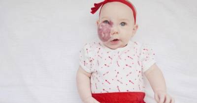 Mom Wants People To Stop Making Stupid Comments About Daughter's Birthmark