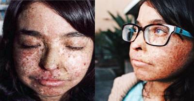 Real Life Vampire Can Only Go Out At Night Because Of Her Condition