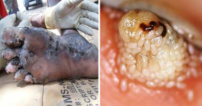 What This Terrifying Bug Can Do Will Make You Cringe