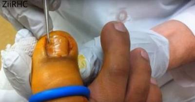 The Doctor Cuts Into This Ingrown Nail, What Happens Next Can&rsquo;t Be Unseen!
