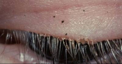 OMG! What The Doctor Found In Her Eyelashes Will Make Your Skin Crawl