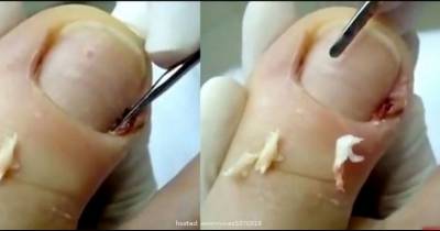 This Pimple Popper Handles An Infected Ingrown Toenail