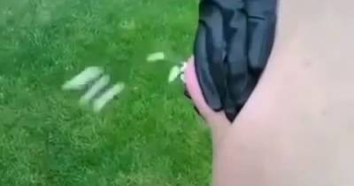 A Man Has A Knee Size Cyst On His Back, It Bursts Out Like A Volcano When Squeezed