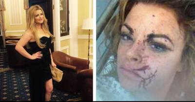 Model Who Was Cut During A Night Out Has Shared Horrific Images Of Her Injuries