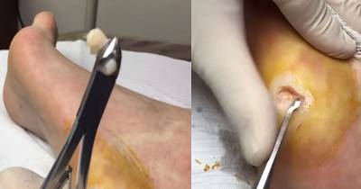 Foot Wart Removals Are Scarier Than You Think