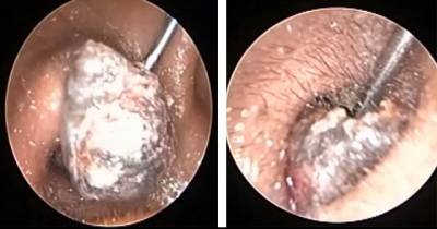 Doctor Removes Hard Impacted Huge Ear Wax In One Stroke
