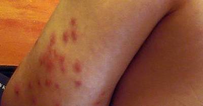 Yuck &ndash; Bed Bugs Be Gone! Get Rid Of The Beasts For Good.