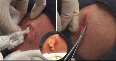 The &ldquo;Bermuda Triangle&rdquo; Of Giant Cysts Erupt In Nasty New Video