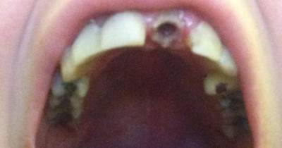 Girl&rsquo;s Asking For Help Because Her Teeth Are Crumbling And Bits Fall Out When She Sneezes