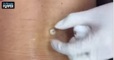 Dr. Pimple Popper Uses Expert Precision To Extract Huge Cyst On Lower Back