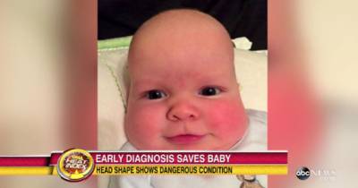Mother Loved Her Baby's Long Head But Whe Doctors Told Her The Truth She Freaked Out
