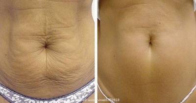 Most Effective Ways To Tighten Your Skin Naturally